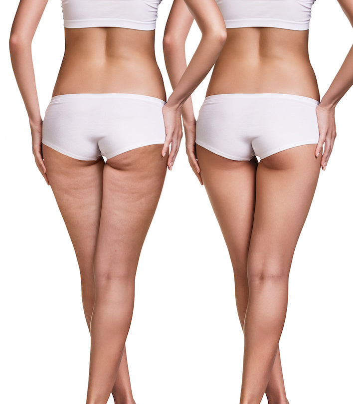 Bum Concerns, Radio Frequency, Gluteal Atrophy, Dermal Filler, Non Surgical BBL, Cool Sculpting, Aqualyx, Manchester, Greater Manchester, Cheshire, Wilmslow, UK, London, Specialist, Rejuvenation, Skin Elasticity, Firmness.
