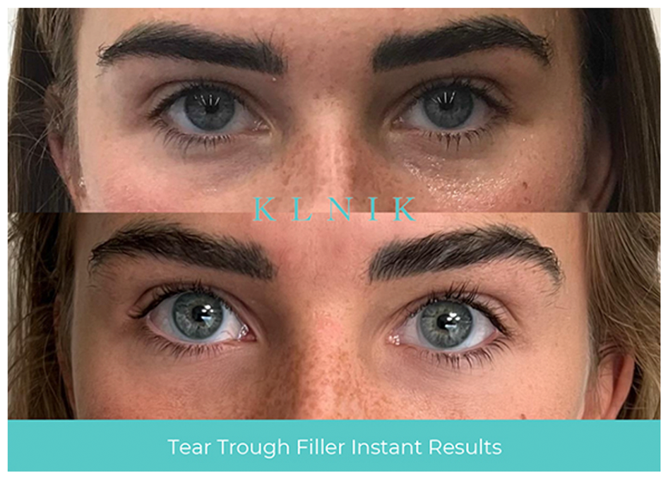 KLNIK Tear Trough Before & After