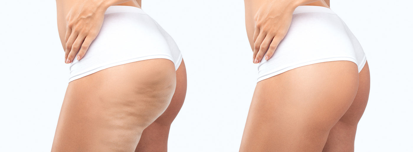 Cellulite, Fat Freezing, Fat Dissolving, Manchester, Greater Manchester, Cheshire, Wilmslow, UK, London, Specialist, Fat Removal, Radio Frequency, Bumpy Skin. 