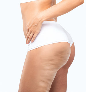 Cellulite, Fat Freezing, Fat Dissolving, Manchester, Greater Manchester, Cheshire, Wilmslow, UK, London, Specialist, Fat Removal, Radio Frequency, Bumpy Skin. 